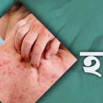হামের উপসর্গ নিয়ে ৫ শিশুর মৃত্যু, আক্রান্ত ১০৬৯