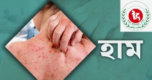 গত ২৪ ঘণ্টায় হামের উপসর্গ নিয়ে ৫ শিশুর&hellip;