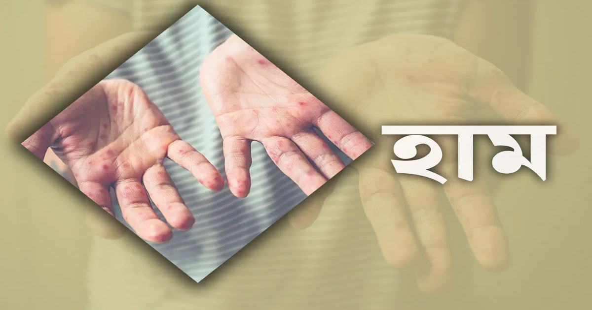 দেশজুড়ে হাম উপসর্গে ঝরল আরও ৭ শিশুর প্রাণ